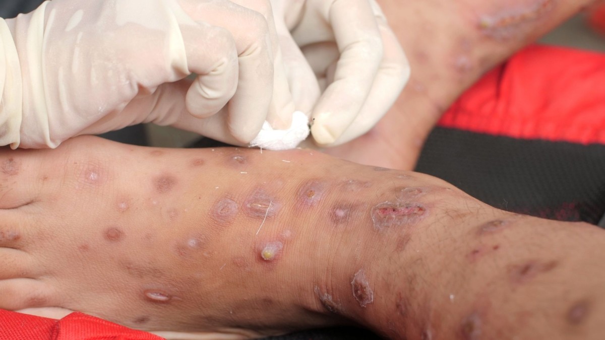 Veteriner Hekim Mustafa Yıldız: 'Uyuz Hastalığı Köpeklerden İnsanlara Geçebilir'